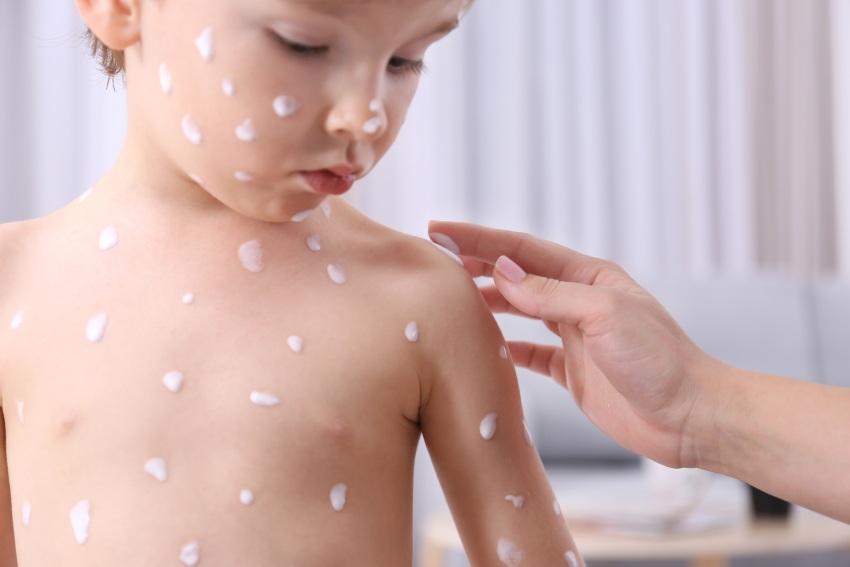 Niño con erupciones cutáneas