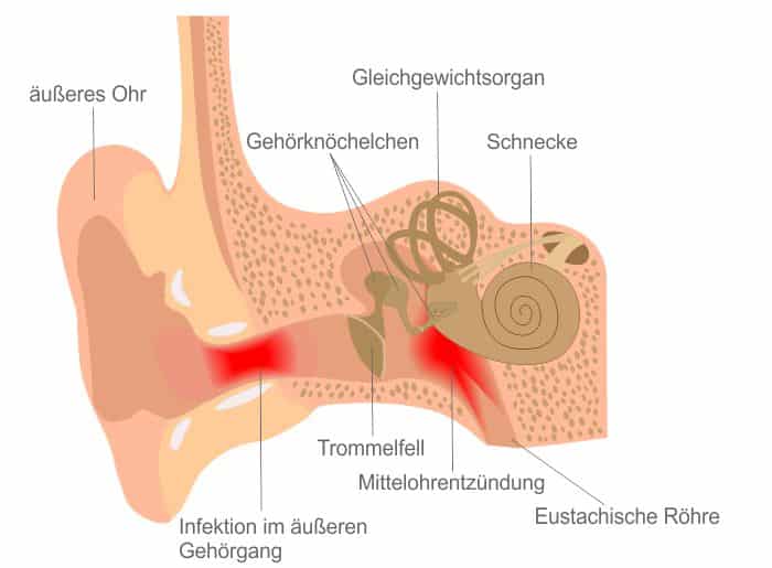 Otitis media